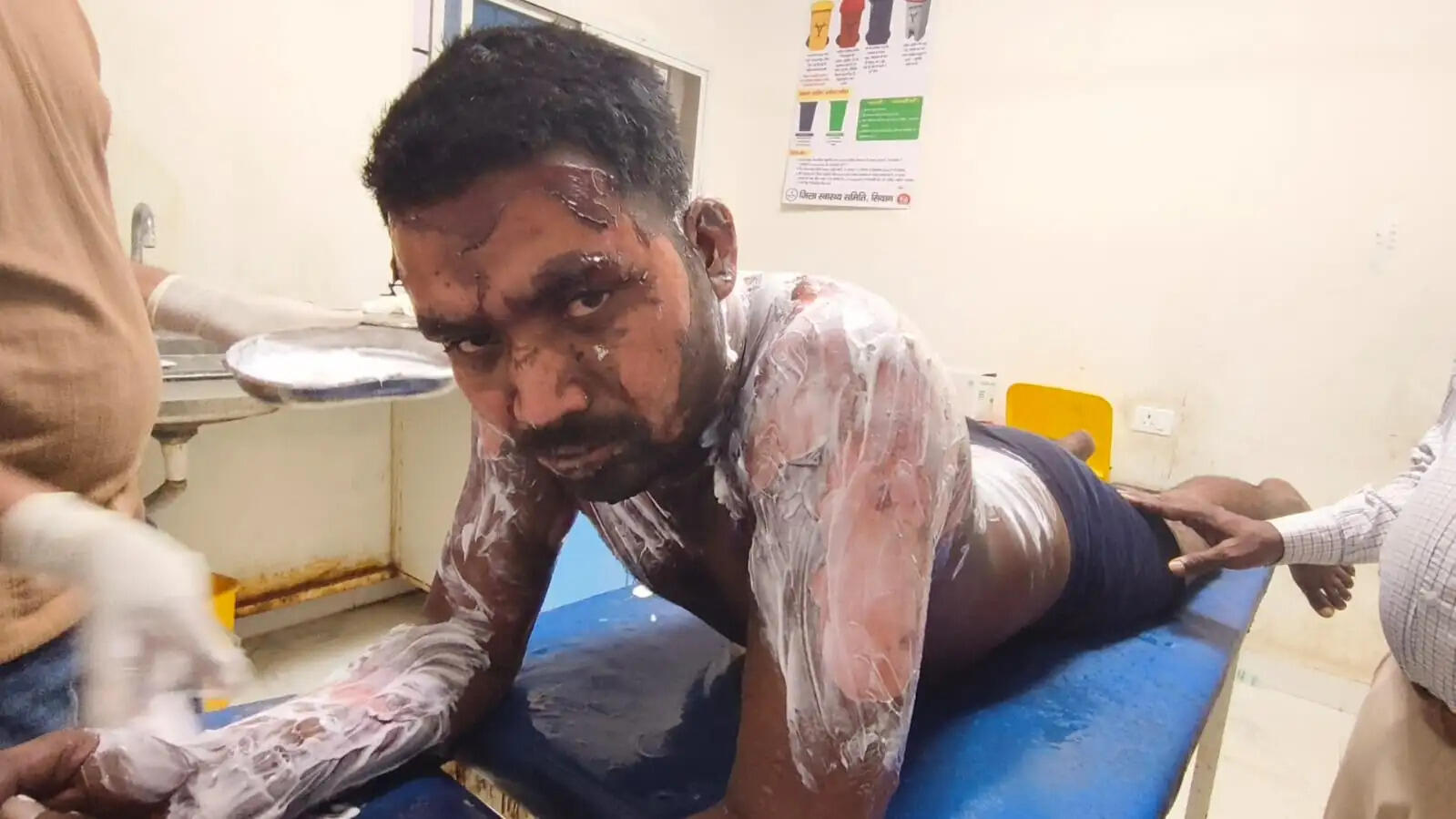 ससुराल बुलाकर युवक को जिंदा जलाने की कोशिश, आधी रात बना खौफ का मंजर