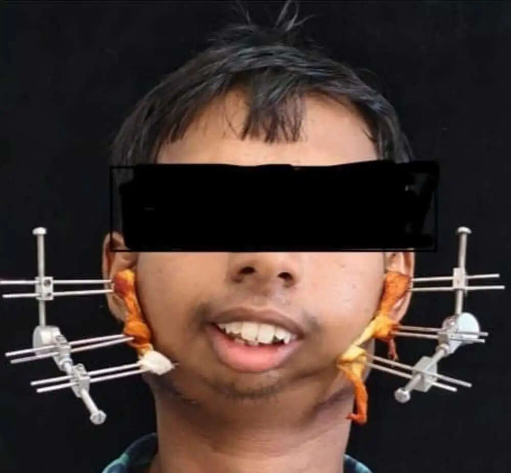 बिलासपुर&nbsp;के&nbsp;सिम्स में 24 वर्षीय युवक के बचपन से बंद जबड़े का सफल ऑपरेशन