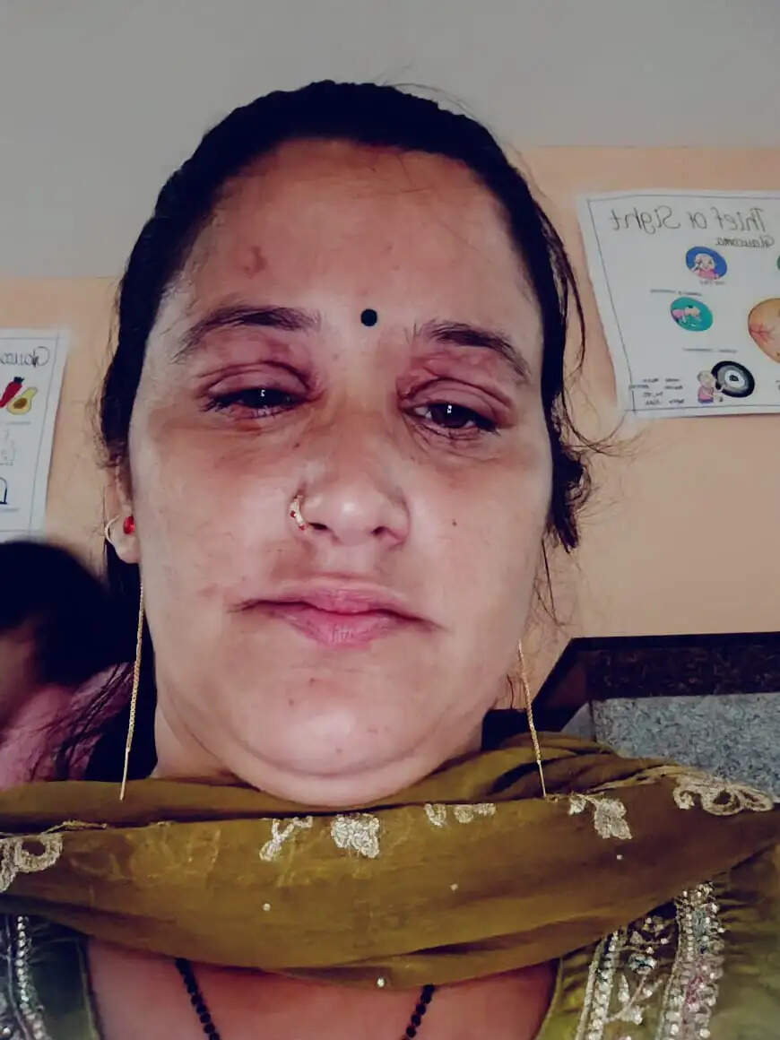 चुनाव दल को खाना बनाती बार फटा कुक्कर, मिड डे मील वर्कर घायल, यूनियन ने सहायता की उठाई मांग