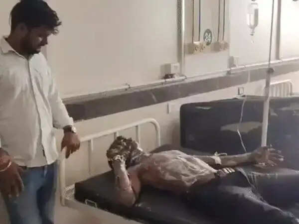 उज्जैन: सिगरेट जलाने माचिस की तीली जलाई, कमरे में भरी एलपीजी गैस में हुआ धमाका, युवक गंभीर रूप से झुलसा