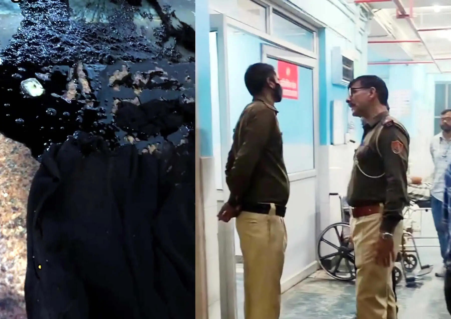 अपडेट-- गुरुग्राम: पति की महिला दोस्त समझकर अस्पताल में दूसरी महिला पर फेंका टॉयलेट क्लीनर