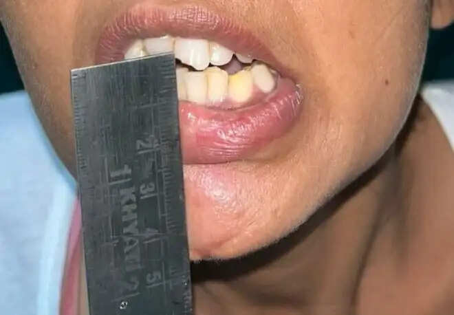 वर्षों से बन्द महिला मरीज का खोला मुंह