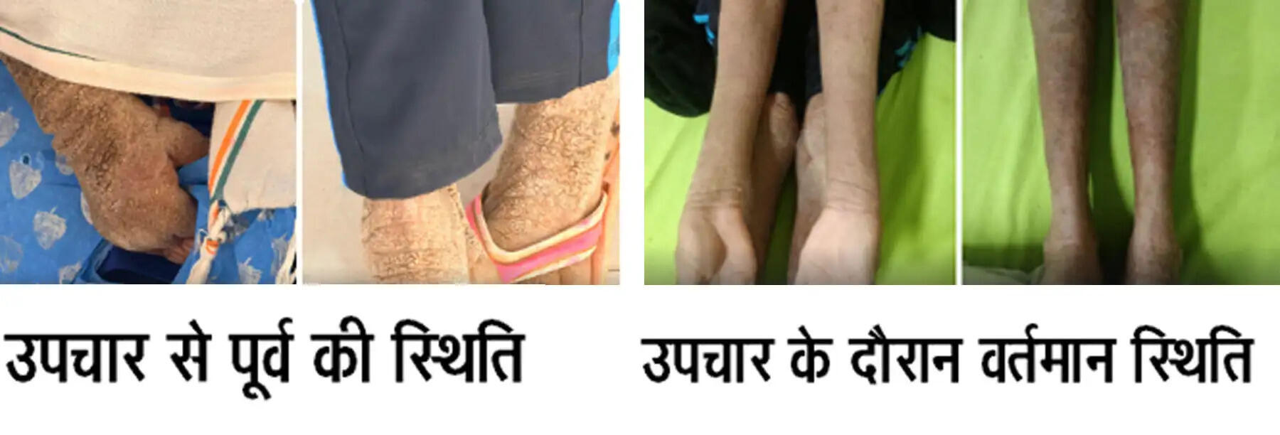 नामुमकिन हुआ मुमकिन, ‘लाइलाज’ समझी जा रही बीमारी का एम्स रायपुर में सफल उपचार