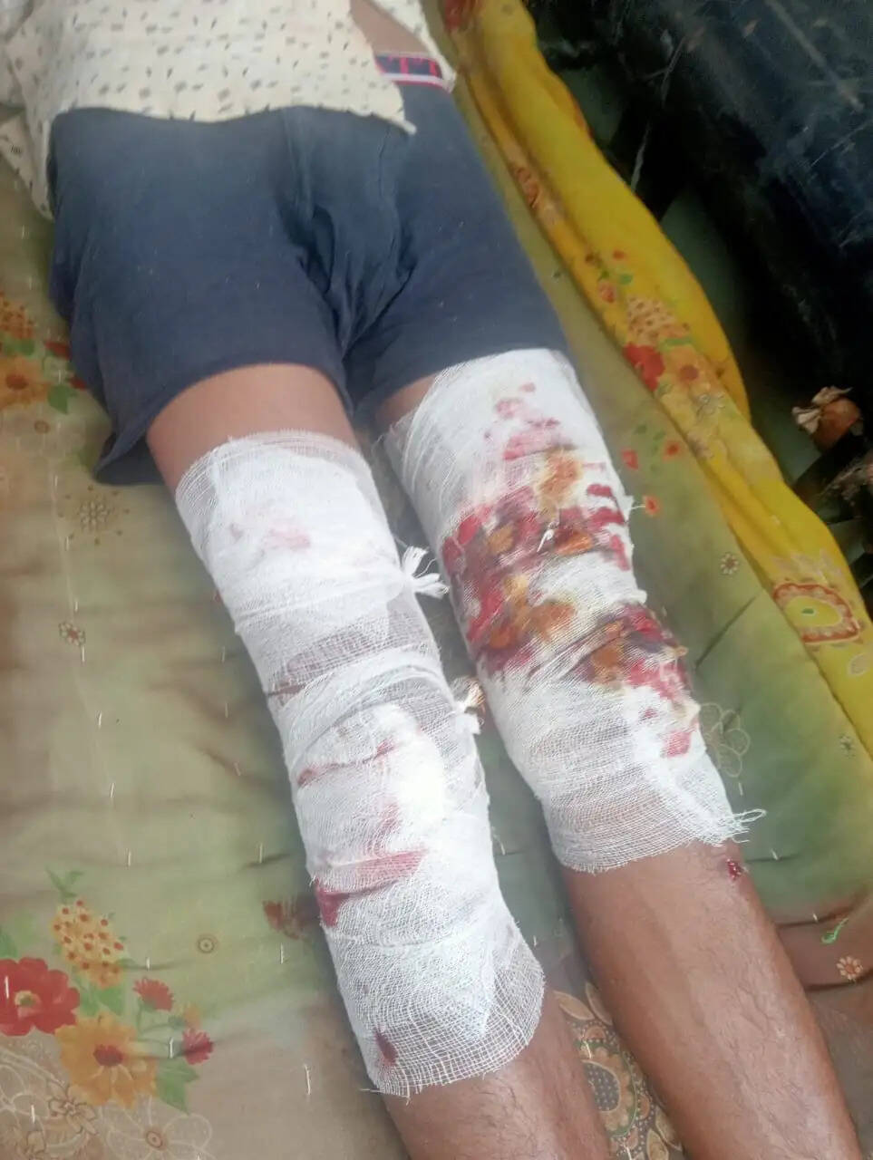 शारदा नदी में मगरमच्छ के जबड़े से मौत को मात देकर निकला युवक, साथियों की मदद से बची जान, हालत गंभीर