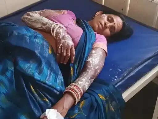 अनूपपुर: ट्रांसफॉर्मर से भड़की आग में तीन घर जले, तीन मवेशियों की मौत, महिला भी झुलसी