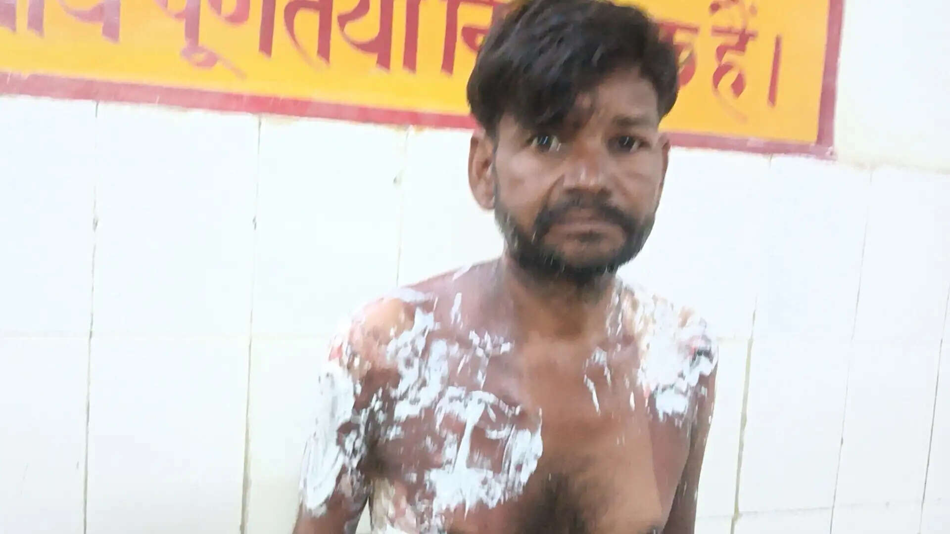 इटावा : रुपये मांगने पर भाभी ने देवर पर फेंका तेजाब