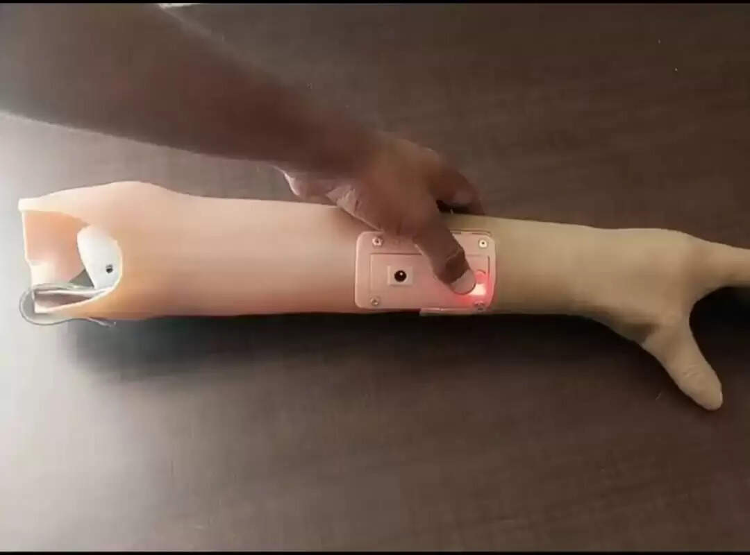 विशेष शिविर में&nbsp;बिना हाथ के दिव्यांगों को लगेंगे निशुल्क इलेक्ट्रॉनिक प्रोस्थेटिक्स हैंड्स