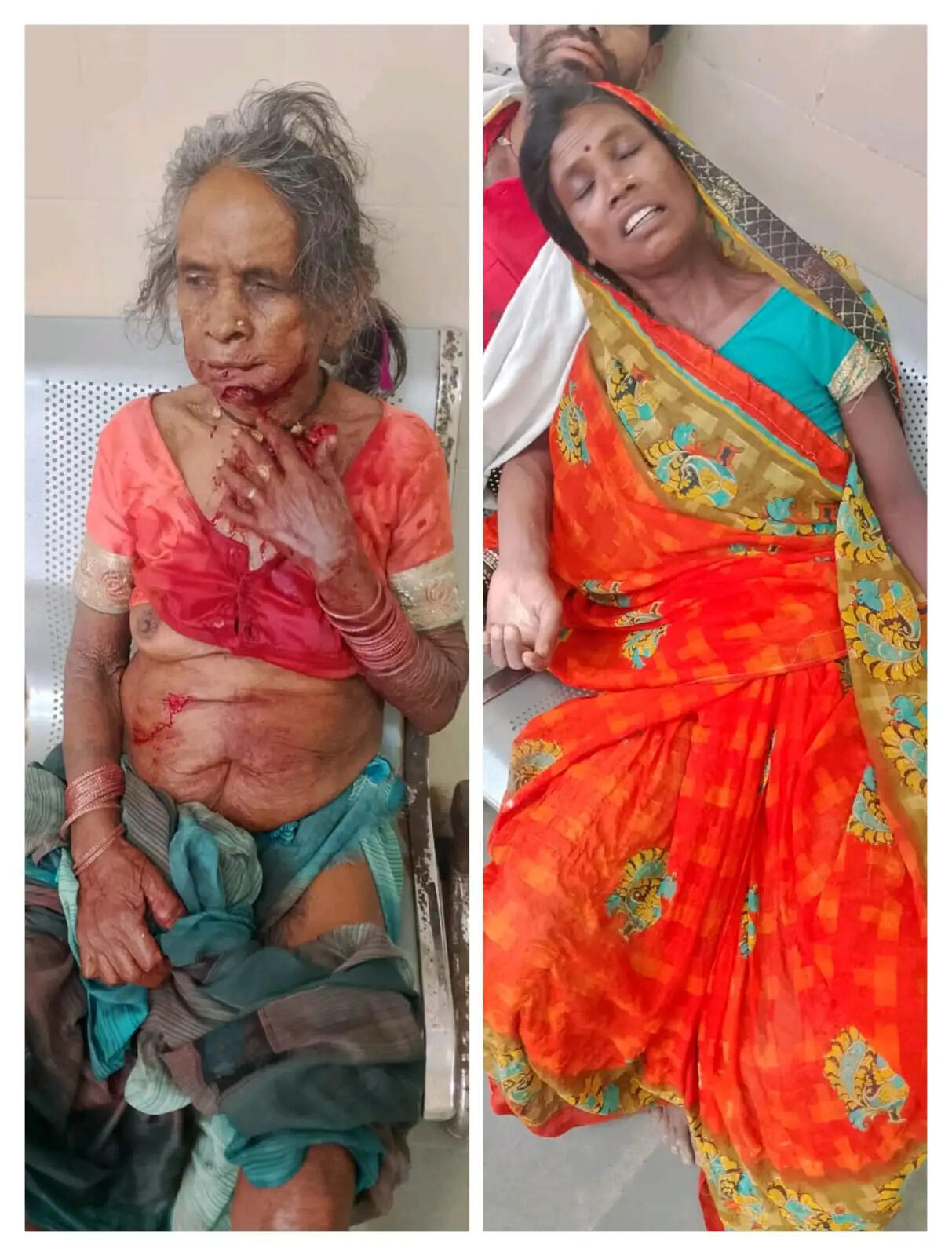अनूपपुर : खेत गईं दो महिलाओं पर भालू का हमला, गंभीर हालत में जिला अस्पताल रेफर